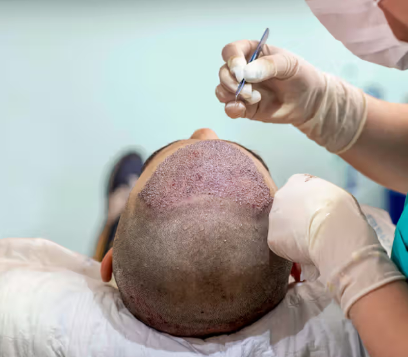 Hair Transplant