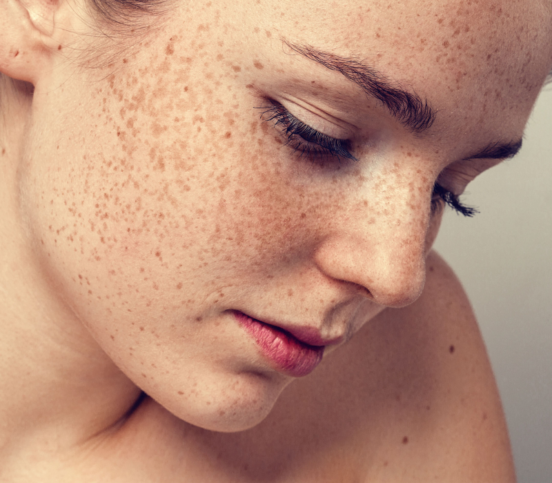 Freckles Removal by Laser