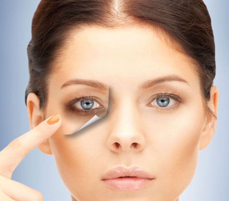 Under Eye Dark Circles Removal by Medical Treatment & Peels