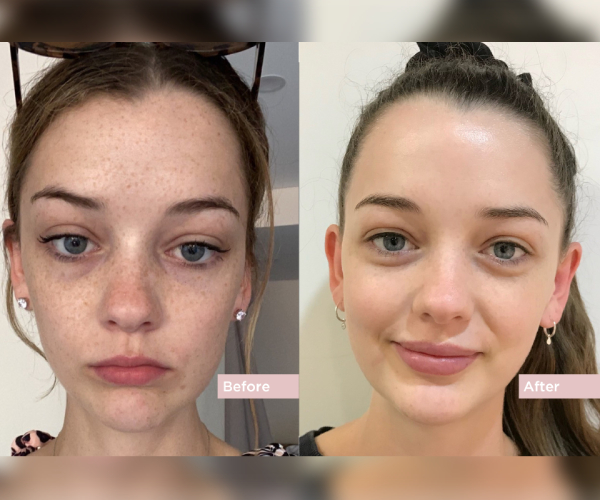 Pigmentation Removal