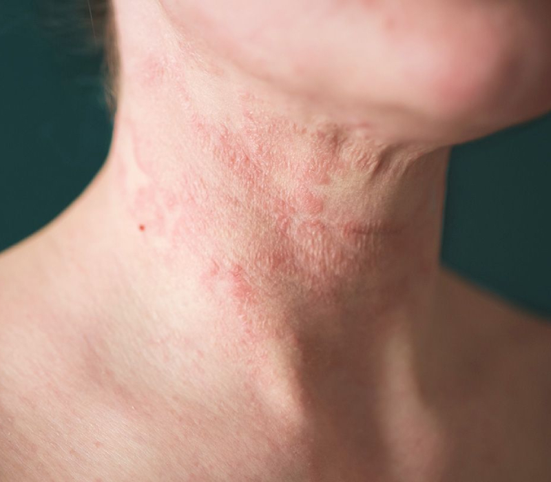 Eczema