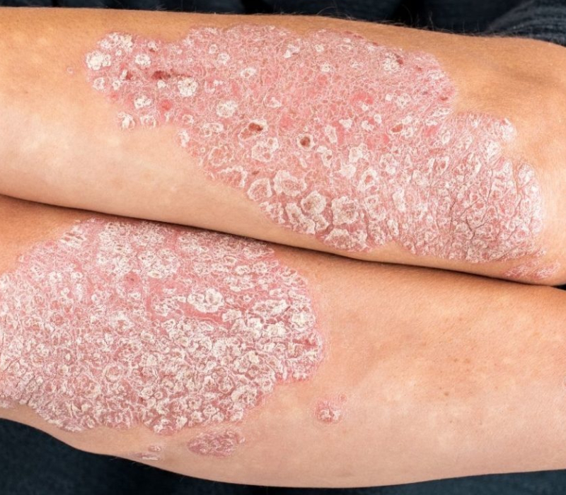 Psoriasis